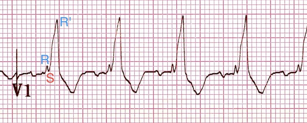 Close-up of V1 lead showing rSR prime pattern characteristic of RBBB with labeled r, S, and R prime components