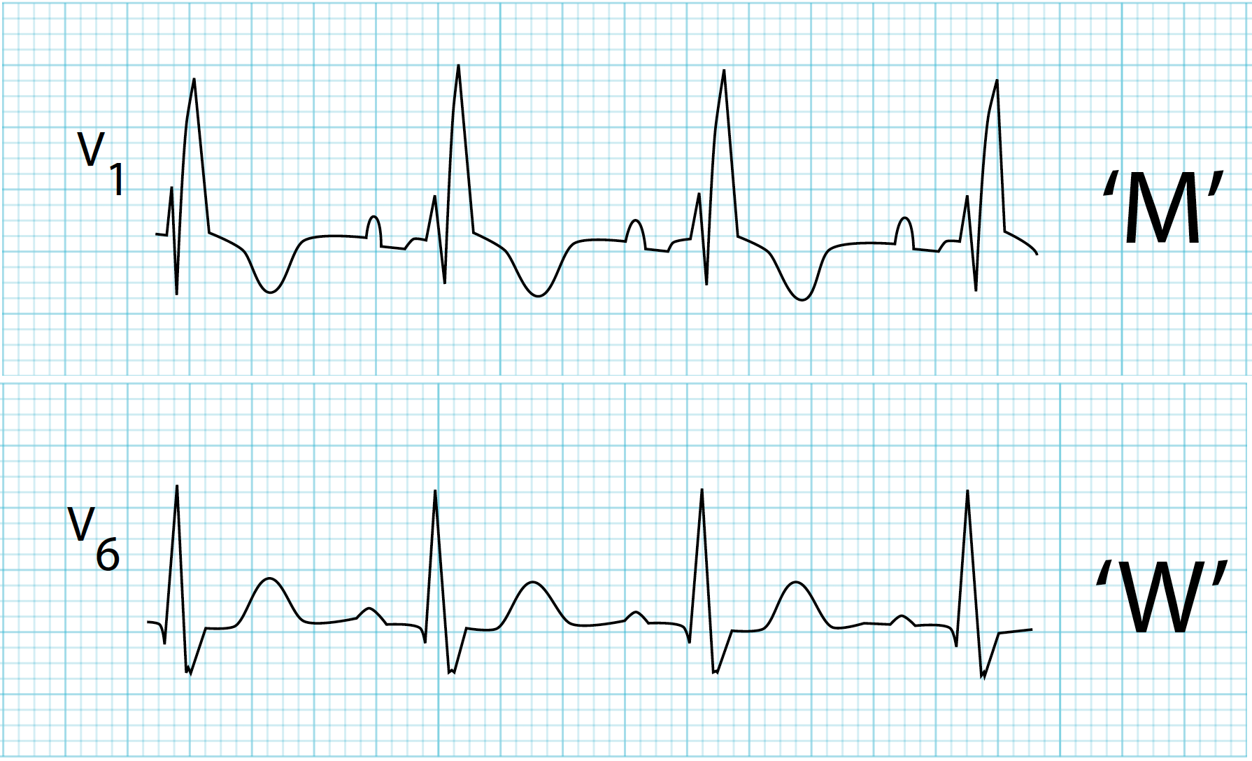 12-lead ECG showing right bundle branch block with rSR prime pattern in V1 and wide terminal S wave in leads I and V6