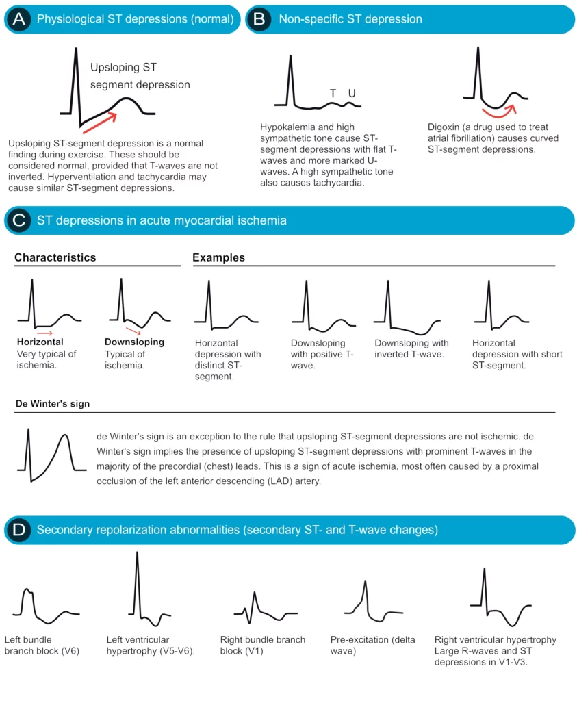 Different types of ST segment depression including horizontal, downsloping, upsloping, and scooped patterns with differential diagnoses