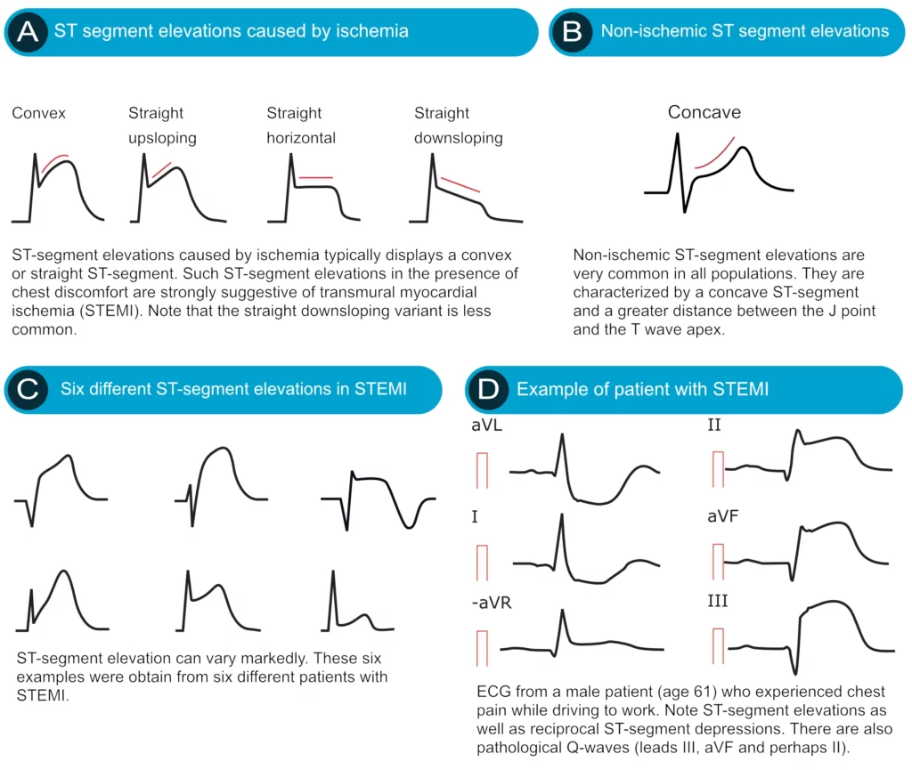 Different morphologies of ST segment elevation including convex, concave, tombstone, coved, and saddleback patterns with their differential diagnoses