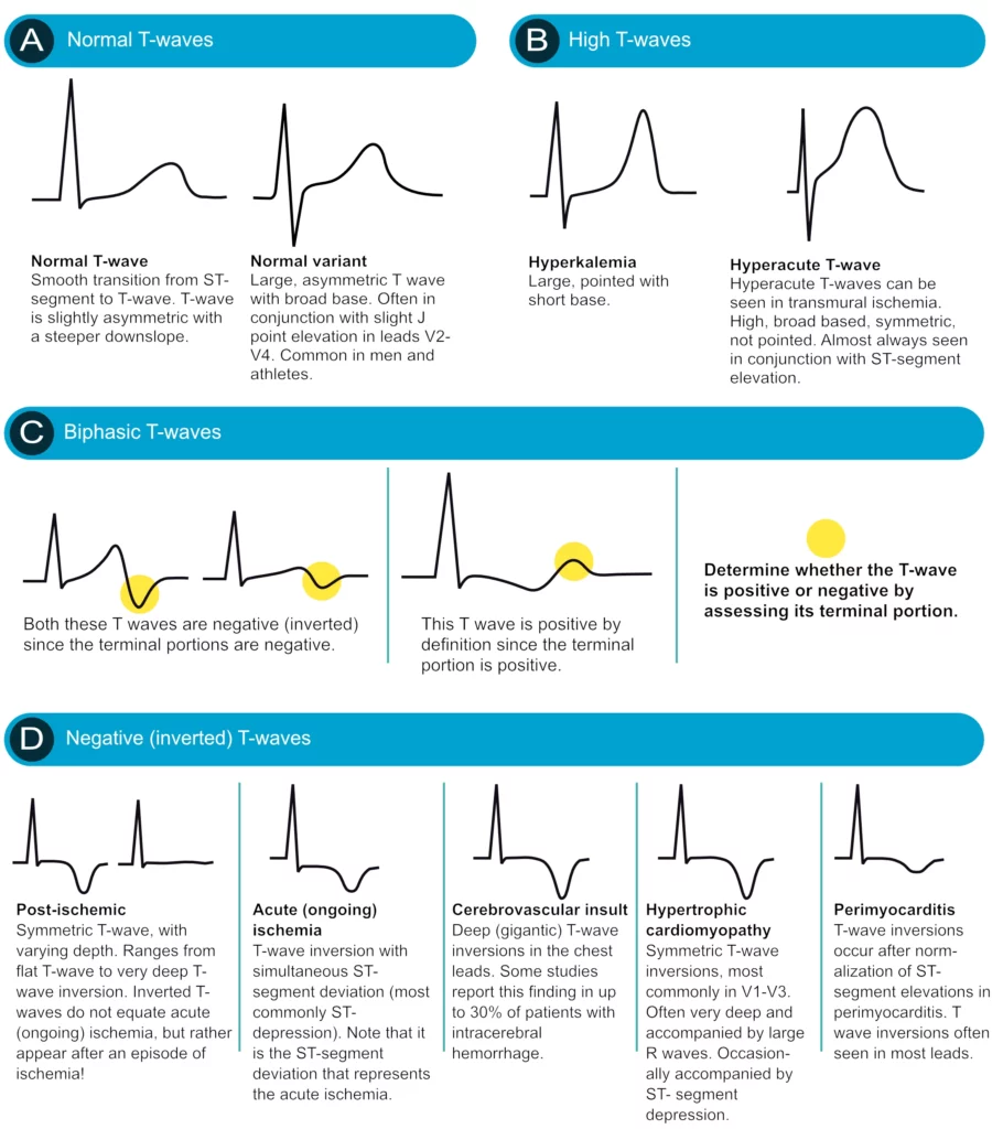 Various T wave morphologies including normal, hyperacute, inverted, biphasic, and deep symmetric patterns with their diagnostic significance
