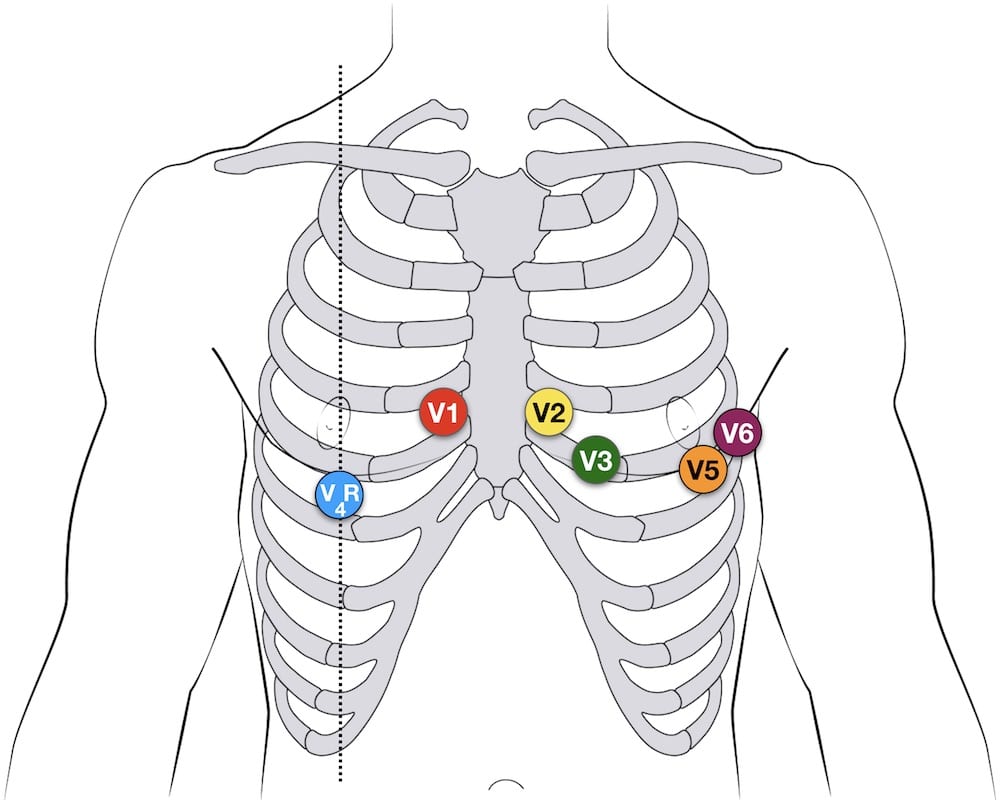 V4R right-sided ECG lead placement for diagnosing right ventricular infarction
