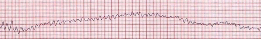 ECG rhythm strip showing ventricular fibrillation with chaotic disorganized electrical activity and no identifiable QRS complexes