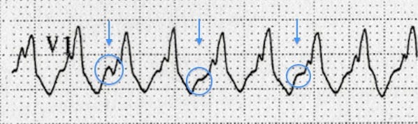 ECG showing ventricular tachycardia with AV dissociation, independent P waves marching through wide QRS complexes