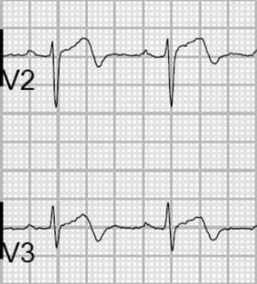 Wellens syndrome type A showing biphasic T waves in leads V2-V3