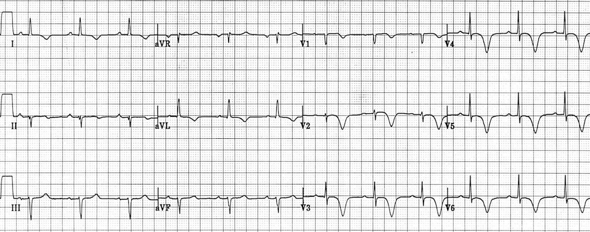 Wellens syndrome type B showing deep symmetric T wave inversions in precordial leads V2-V3