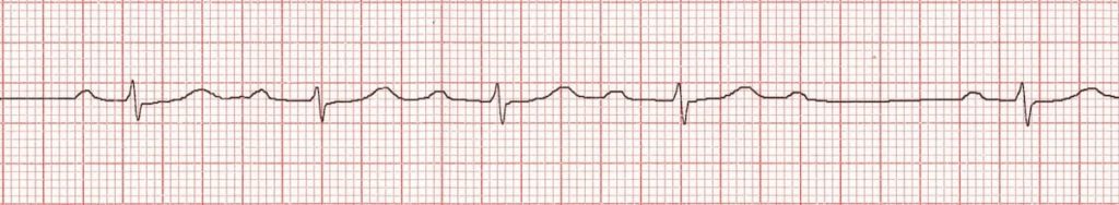 ECG rhythm strip showing Mobitz type I (Wenckebach) second-degree AV block with progressive PR prolongation and dropped QRS