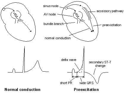 12-lead ECG showing Wolff-Parkinson-White pattern with short PR interval, delta waves, and widened QRS