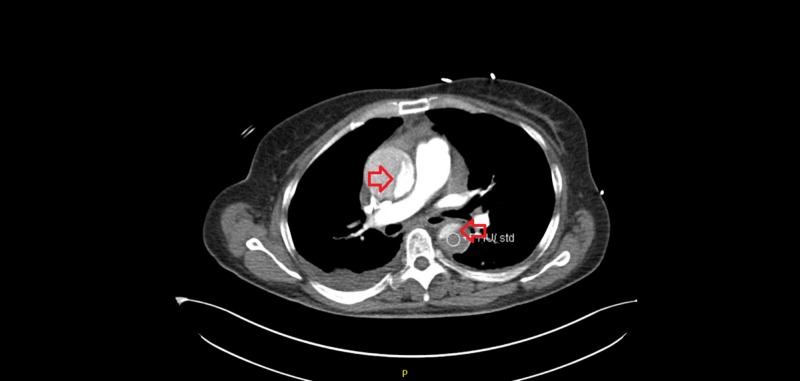 CT angiogram showing Stanford Type A aortic dissection with intimal flap