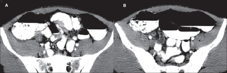 CT scan of acute appendicitis showing dilated appendix with fat stranding