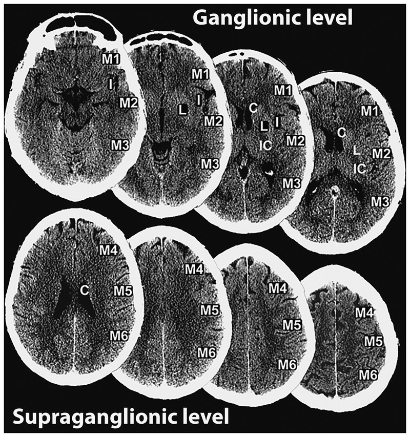 Diagram of ASPECTS scoring regions in the MCA territory on axial CT