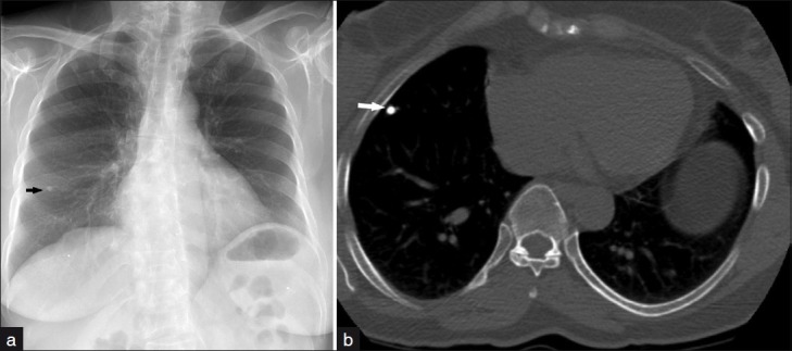 CT scan showing a calcified pulmonary granuloma with corresponding chest radiograph
