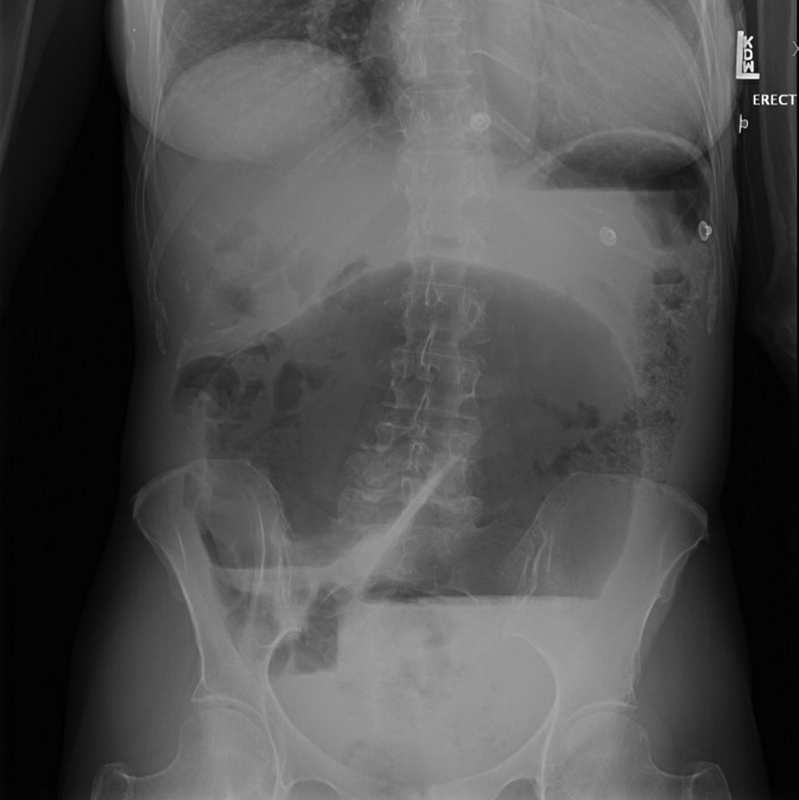 Abdominal radiograph showing cecal volvulus with dilated cecum