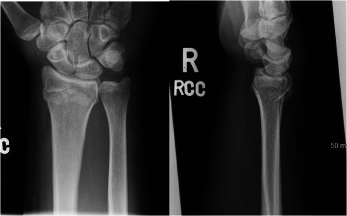 Posteroanterior and lateral radiographs of a distal radius fracture