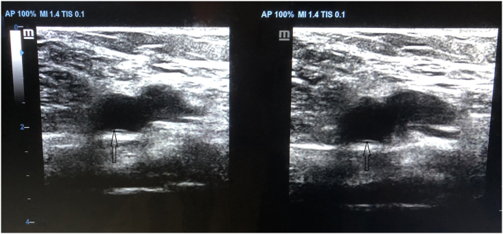 Compression ultrasound showing non-compressible popliteal vein diagnostic of deep vein thrombosis