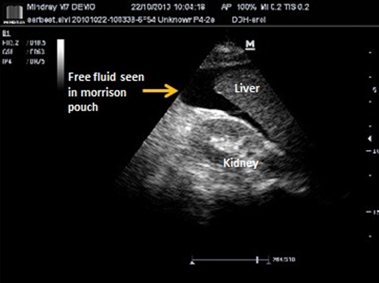 Ultrasound of Morison pouch showing free fluid (blood) around the liver in trauma