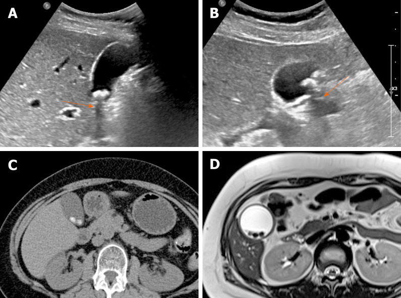 Ultrasound of gallbladder showing gallstones with posterior acoustic shadowing