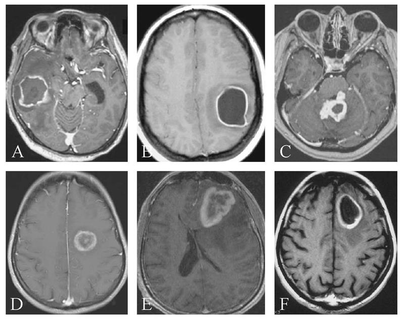 MRI of glioblastoma showing ring enhancement with central necrosis on post-contrast T1