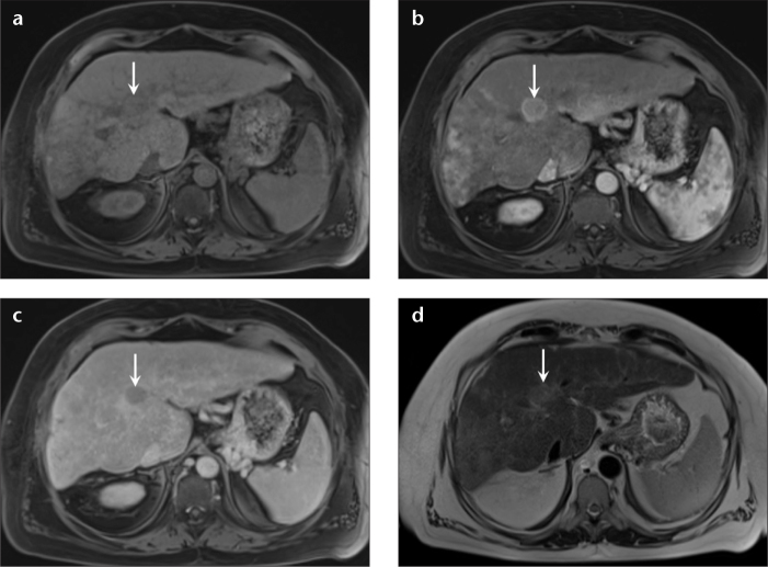 MRI of hepatocellular carcinoma showing arterial enhancement and washout on dynamic contrast imaging