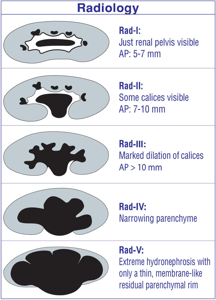 Ultrasound grading system for hydronephrosis showing progressive dilation