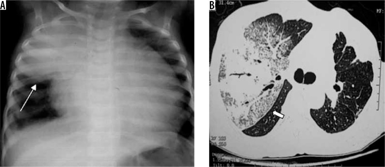 Chest radiograph and CT showing Klebsiella pneumonia with lobar consolidation and bulging fissure
