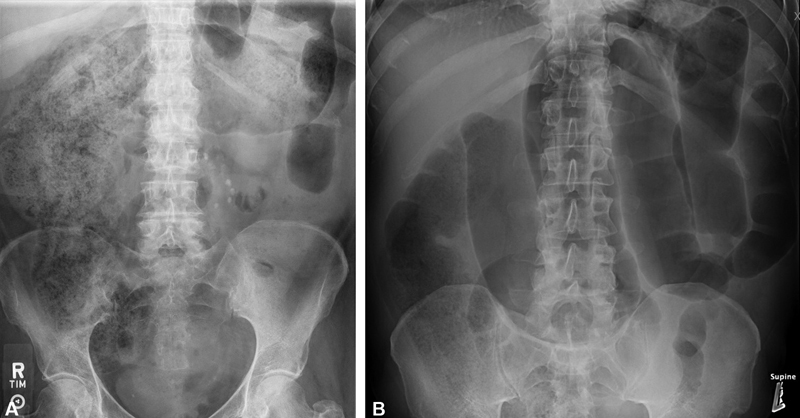 Abdominal radiograph showing large bowel obstruction with dilated colon