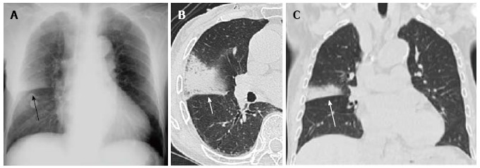 Chest radiograph and CT showing lobar pneumonia with consolidation