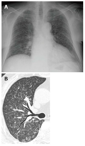 Chest radiograph and CT showing miliary tuberculosis with diffuse tiny nodules