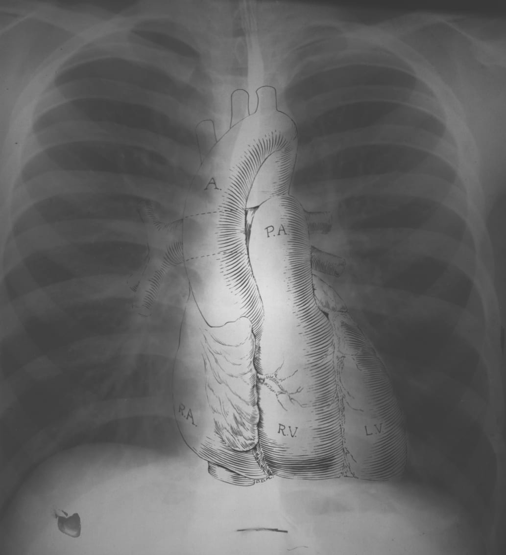 Normal PA chest radiograph with labeled anatomical landmarks