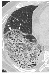 CT showing organizing pneumonia pattern with peripheral consolidation