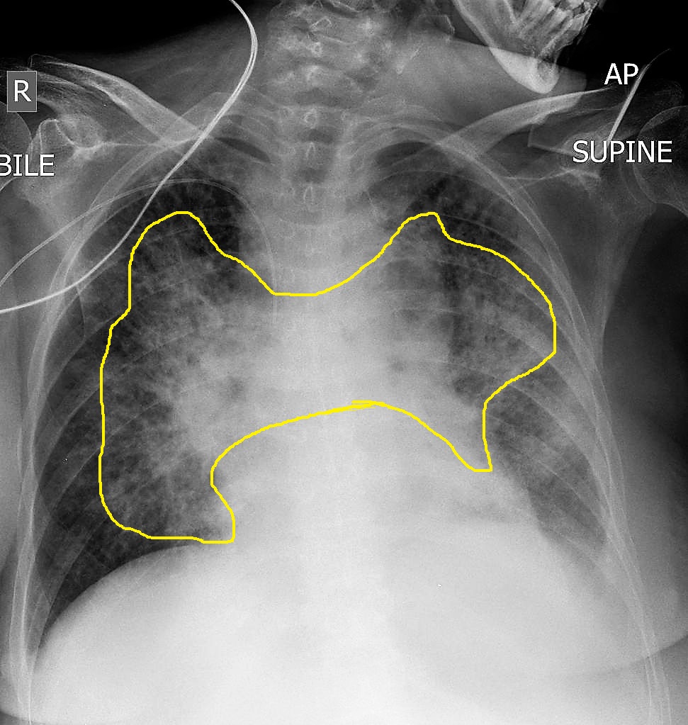Chest radiograph showing bilateral perihilar bat-wing pattern of pulmonary edema