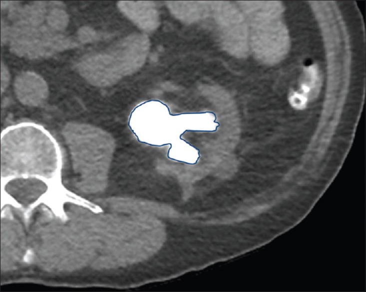 Non-contrast CT showing renal calculus with volumetric assessment