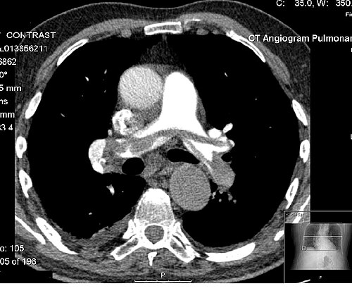CT pulmonary angiography showing a saddle pulmonary embolism straddling the main pulmonary artery bifurcation