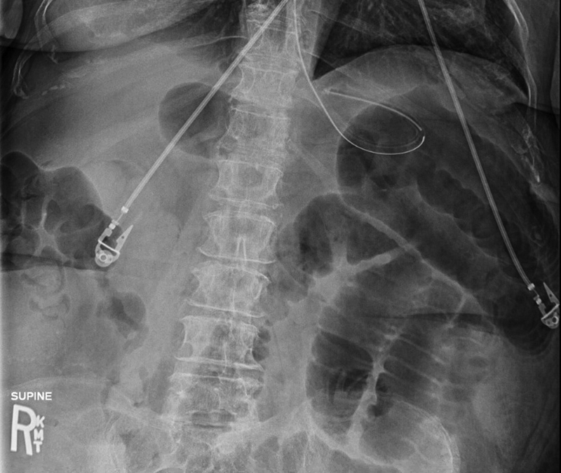 Abdominal radiograph showing small bowel obstruction with dilated loops and air-fluid levels