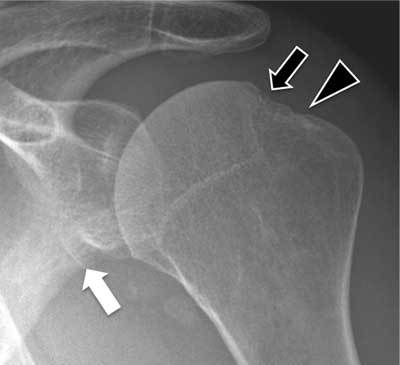 Radiograph showing anterior shoulder dislocation with Hill-Sachs and Bankart lesions