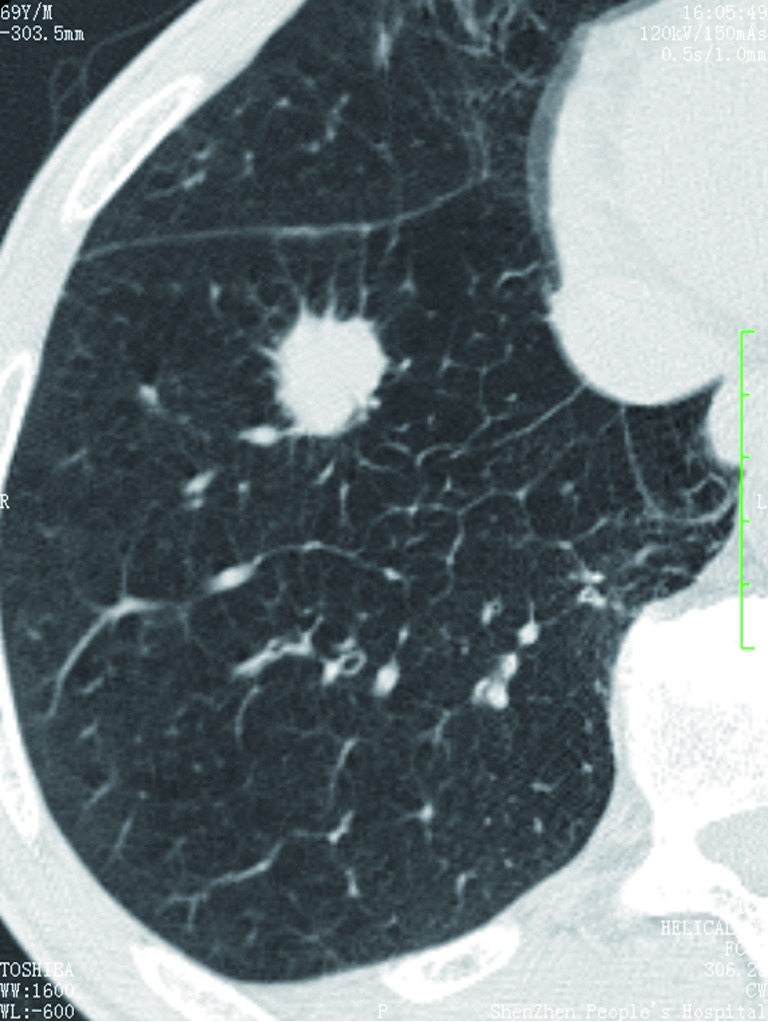 CT scan showing a spiculated solitary pulmonary nodule suspicious for malignancy