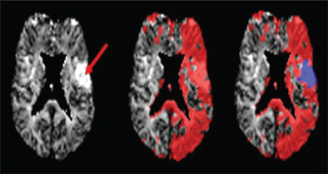 Multimodal MRI of acute ischemic stroke showing DWI, ADC, MRA, and perfusion maps