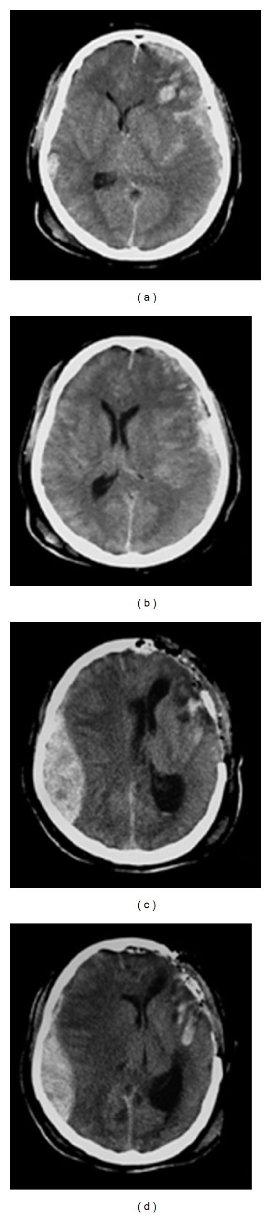Axial CT showing subdural hematoma with midline shift and contralateral epidural hematoma