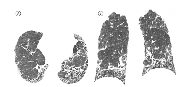 HRCT showing usual interstitial pneumonia pattern with honeycombing and traction bronchiectasis