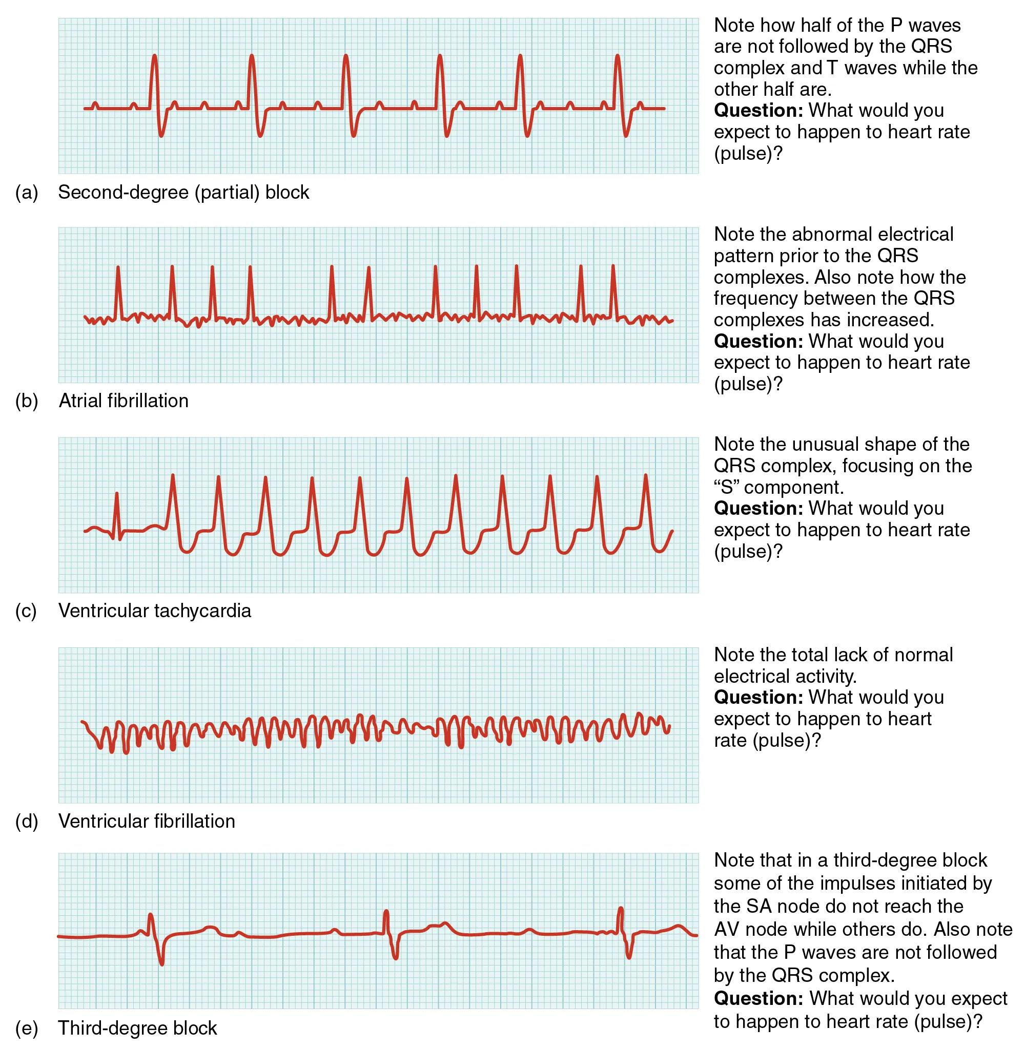 Examples of common ECG abnormalities including atrial fibrillation, ventricular tachycardia, heart blocks, and other arrhythmias