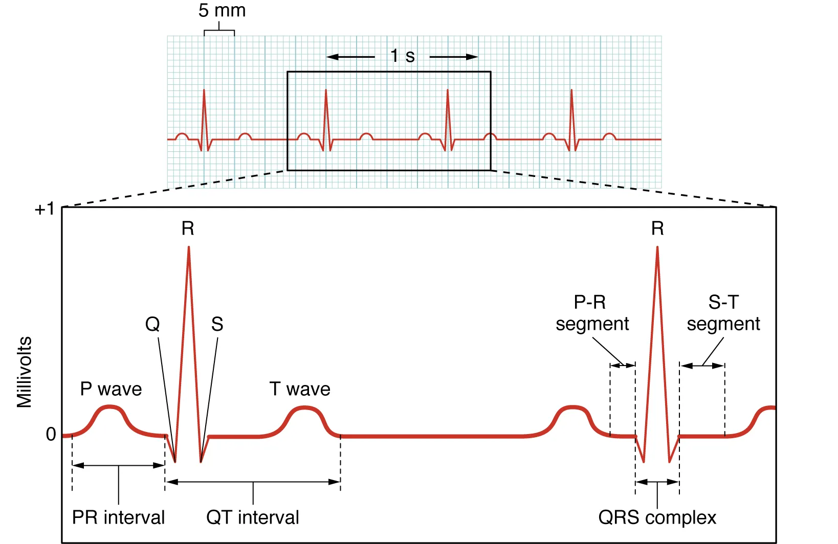 Normal ECG tracing showing labeled P wave, QRS complex, T wave, and standard intervals
