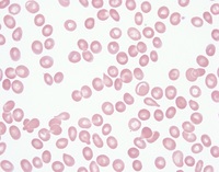 Peripheral blood smear showing schistocytes (fragmented red blood cells) characteristic of microangiopathic hemolytic anemia