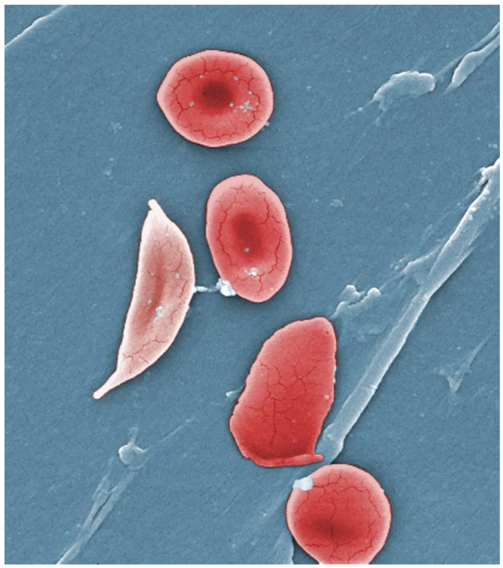 Comparison of normal red blood cells and sickle-shaped erythrocytes showing the characteristic crescent deformity in sickle cell disease