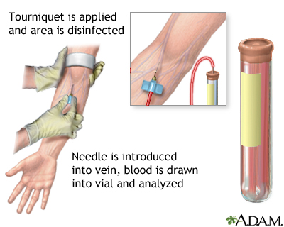 Blood draw from the arm showing tourniquet application and needle in vein