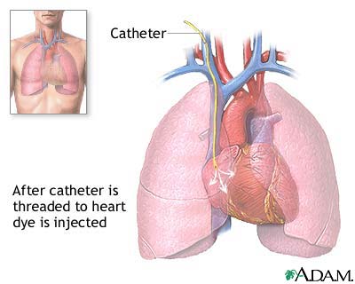 Cardiac catheterization showing catheter insertion via vessel access