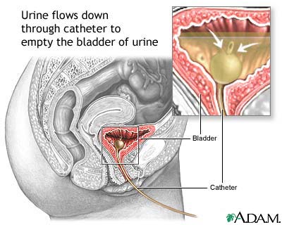 Female urinary catheterization anatomy showing Foley catheter placement