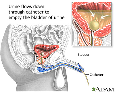 Male urinary catheterization anatomy showing Foley catheter placement