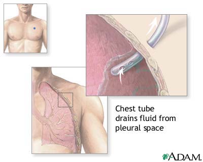 Chest tube insertion procedure showing tube placed through the chest wall