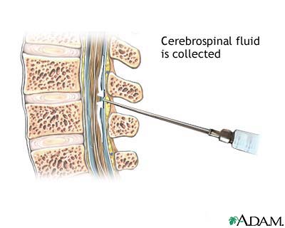Cerebrospinal fluid collection showing specimen tubes