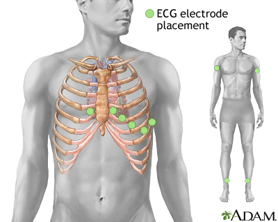 ECG electrode placement on the chest showing precordial lead positions V1-V6